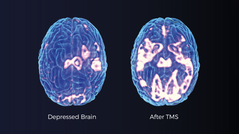 How does TMS therapy work?